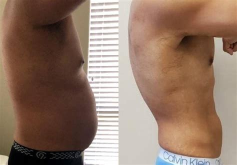 Laser Lipo Treatment For in Orange County