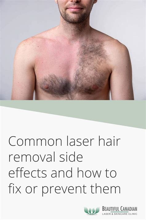 Common Laser Hair Removal Side Effects And How To Fix or Prevent Them