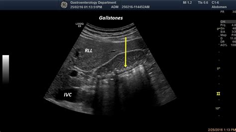 Gallbladder Sludge