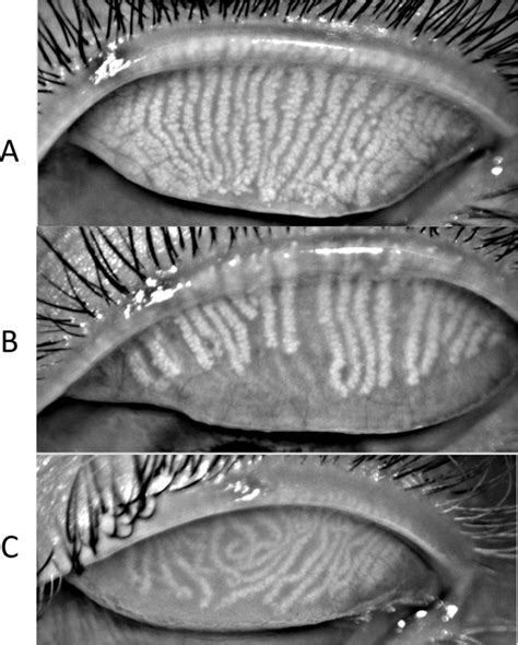 Meibomian-gland-characteristics-A-Typical-Meibomian-gland-orientation ...