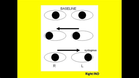 Conjugate Vertical Gaze