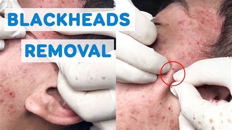 Blackhead Removal Videos June 2024 - Dniren Zabrina