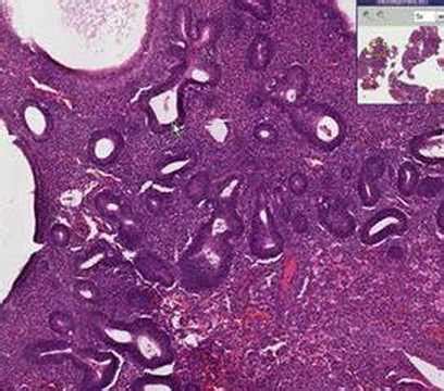 Histopathology Endometrium --Hyperplasia - YouTube