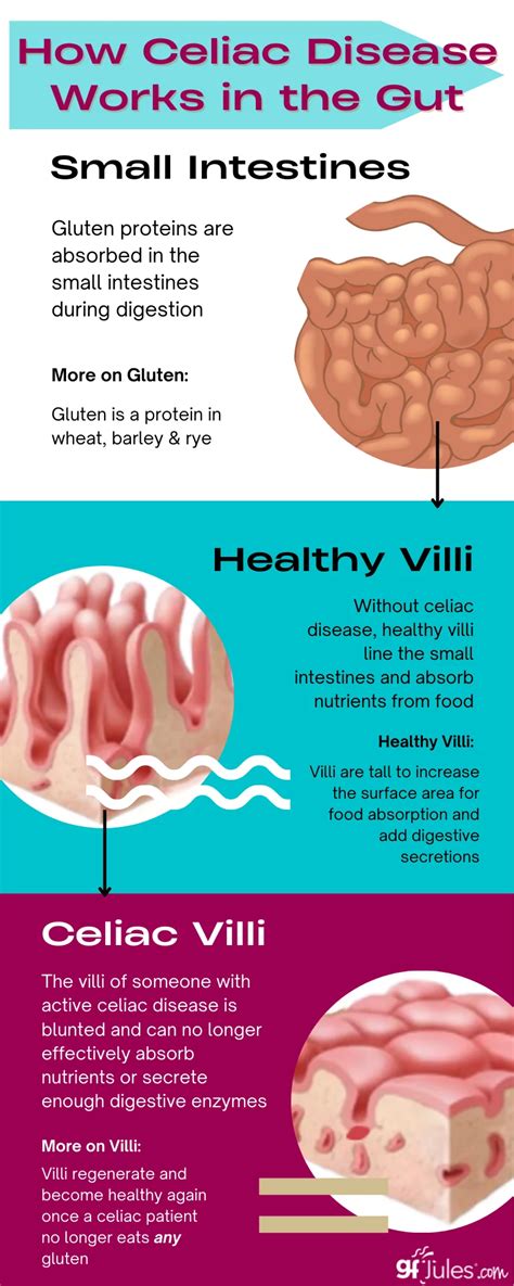 Celiac Disease -- What it is, what it isn't--knowing the difference