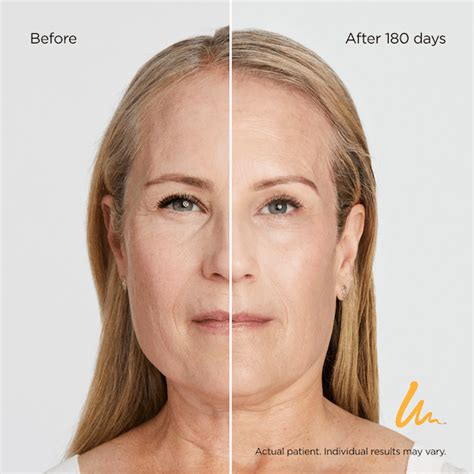 Ultherapy in NYC | Non-Surgical Lift and Skin Tightening Manhattan