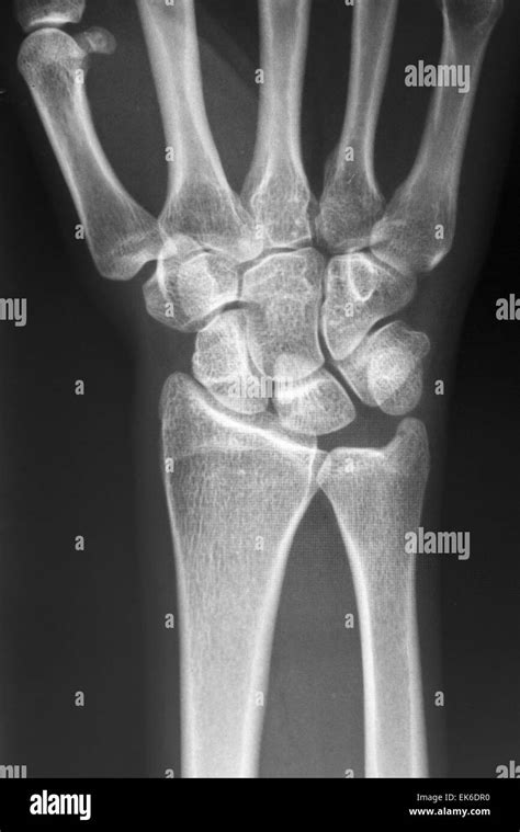 X Ray Hand Bones