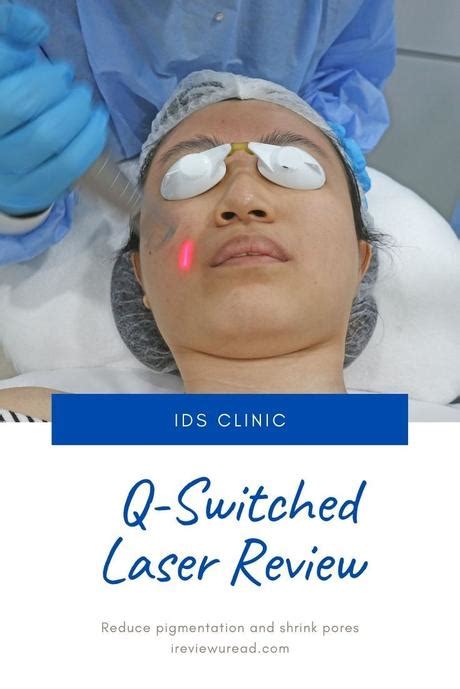 How I Reduce Pigmentation with Q Switch Laser Treatment | IDS Clinic ...