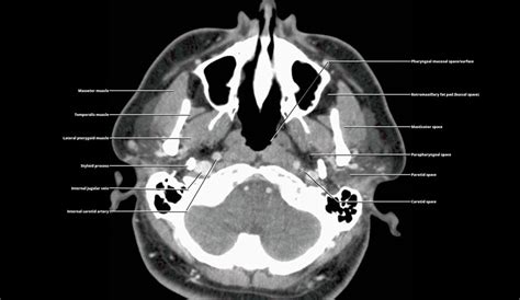 Suprahyoid and Infrahyoid Neck Overview | Radiology Key