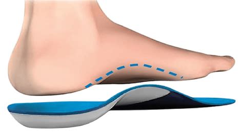 Orthotics | Foot Orthoses | ACC Chiropractic Clinic