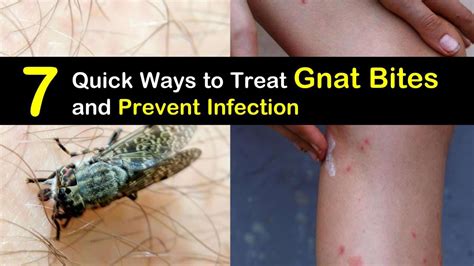 7 Quick Ways to Treat Gnat Bites and Prevent Infection | Gnat bites ...