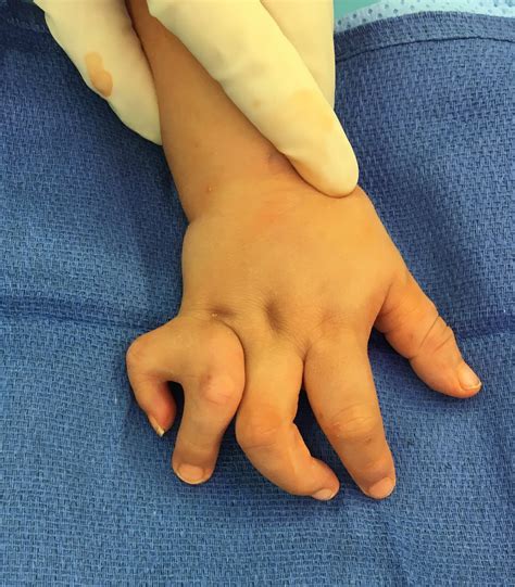 Unusual "Extra" Finger | Congenital Hand and Arm Differences ...