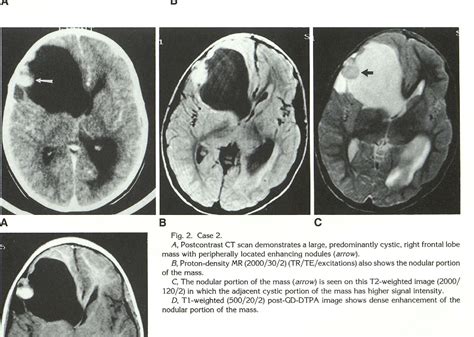 Figure 2 from Pleomorphic xanthoastrocytoma | Semantic Scholar