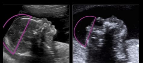 Acrania/Anencephaly – Snellustrations