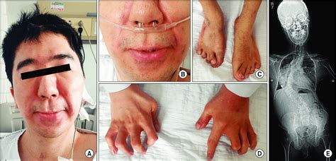 Characteristic features of Freeman-Sheldon syndrome. (A, B) Face of the ...