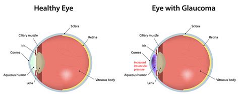 Glaucoma Treatment Attleboro | Glaucoma Surgery Pawtucket | Dr. Fay