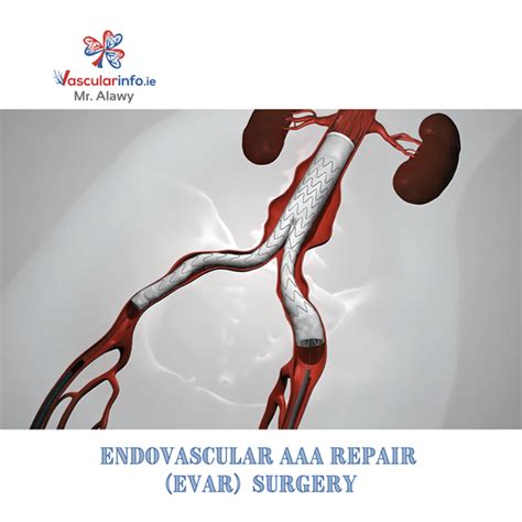 Endovascular AAA Repair - Vascular Info