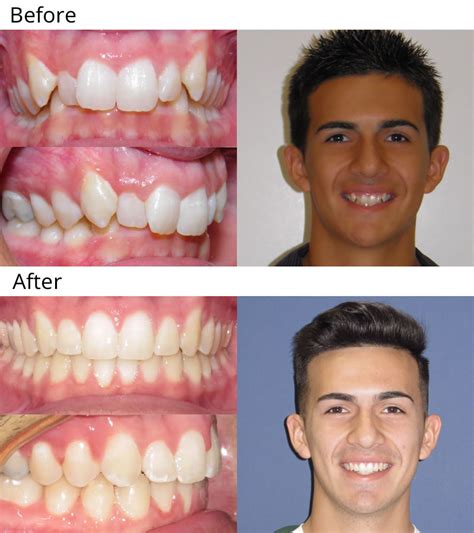 Before And After Braces Gaps