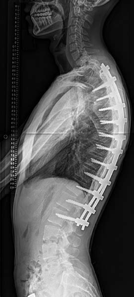 Kyphosis (Forward Curvature of the Spine) | HSS Spine