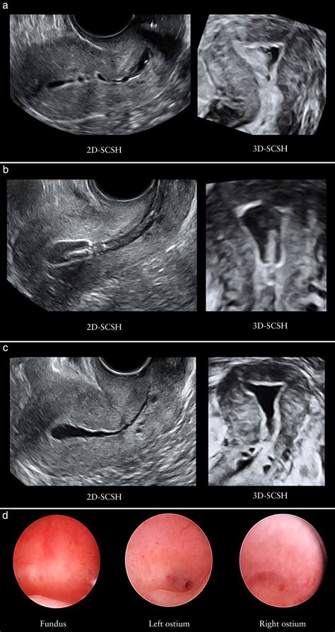 Ultrasound‐guided treatment of intrauterine adhesions in the outpatient ...