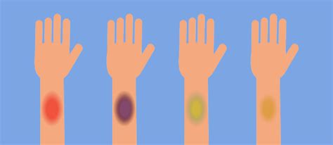 Hematoma vs Bruise: How to Tell the Difference - BuzzRx