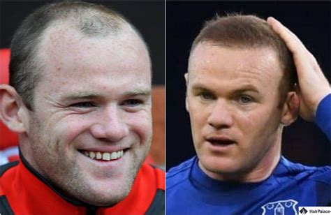 A. Townsend Hair Transplant: Behind the Spectacular Result