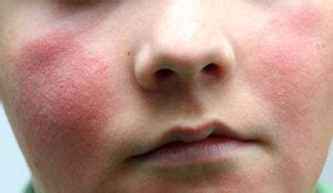 What is Slapped Cheek Syndrome? - Lowton and Golborne News