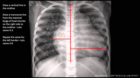 Cardiomegaly Chest Xray