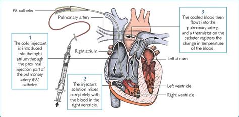 Cardiac Output Measurement | Nurse Key