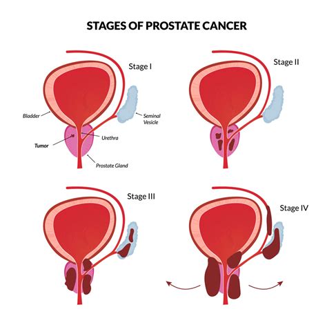 Prostate Cancer Symptoms