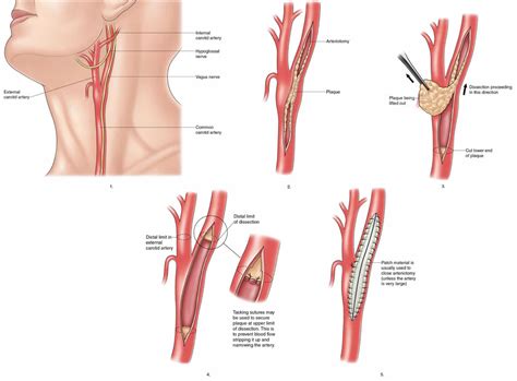 Carotid endarterectomy indications, risks, complications & recovery