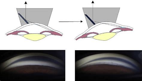 Schematic drawings and representative images on gonioscopy. Left ...