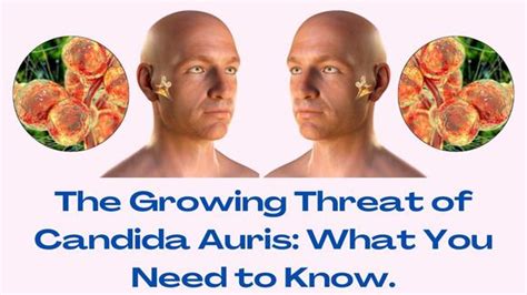 Candida Auris: Symptoms, Causes, Diagnosis, Treatment | atelier-yuwa ...