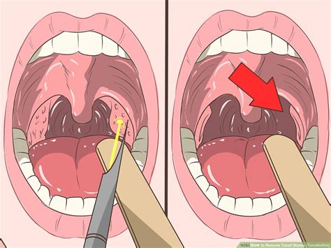 aid1351224-v4-1200px-Remove-Tonsil-Stones-(Tonsilloliths)-Step-17 ...