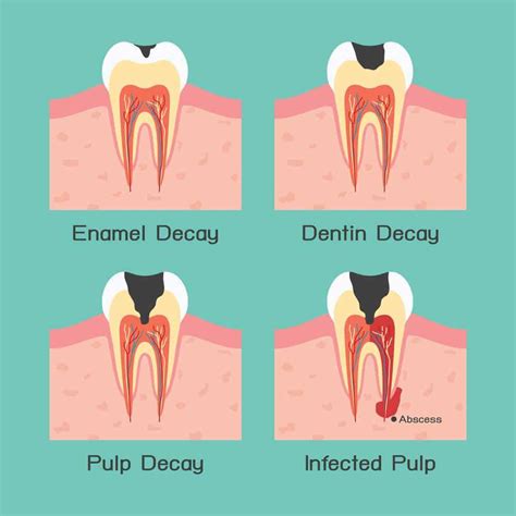 Tooth Abscess Stages Pictures : What To Look For?