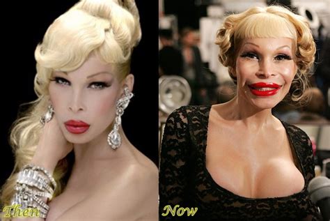 Amanda Lepore Botched Plastic Surgery Story | Celebrity Bad Plastics ...