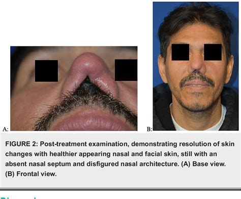 Figure 1 from Clinical Diagnosis and Management of Mucosal ...