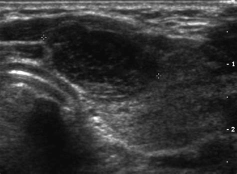 Lymphoma On Ultrasound