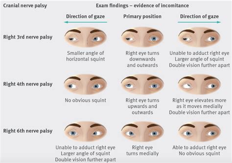 Re: Cranial Nerve III Palsy(Oculomotor nerve palsy) - 12 신경질환의 탐구 - 치료적 ...