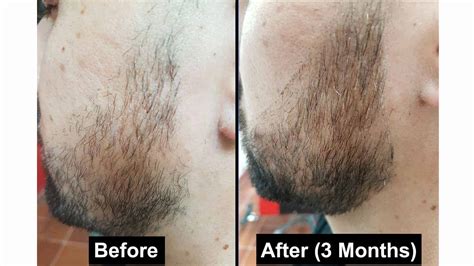 Minoxidil Beard Treatments: Can It Really Grow a Better Beard?