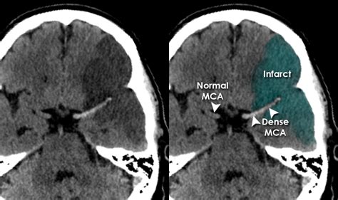 Stroke Ct Scan