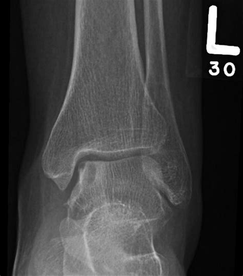 Osteochondral Lesions of the Talus - Foot & Ankle - Orthobullets