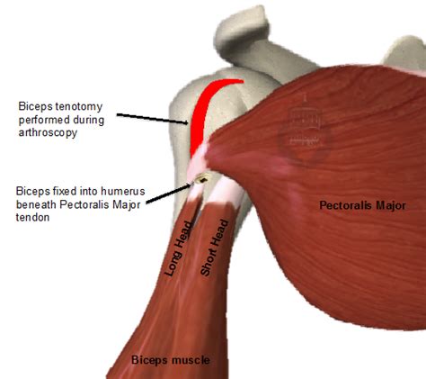 Biceps tenotomy or tenodesis