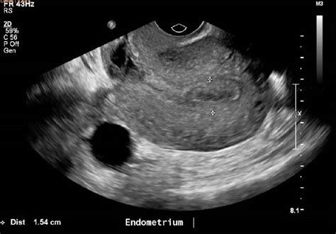 [36+] Uterine Cancer Ultrasound Endometrial Hyperplasia