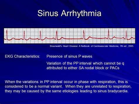 Arrhythmias and EKGs Part 2 Outline Sinus Arrhythmia