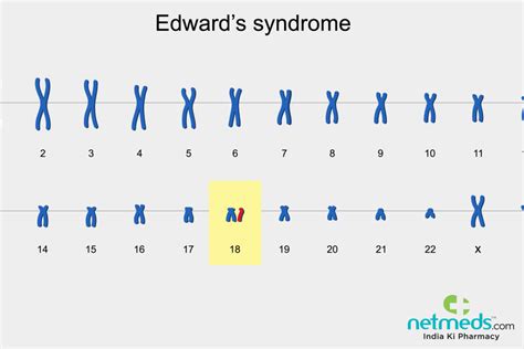 Edward’s Syndrome: Causes, Symptoms and Treatment