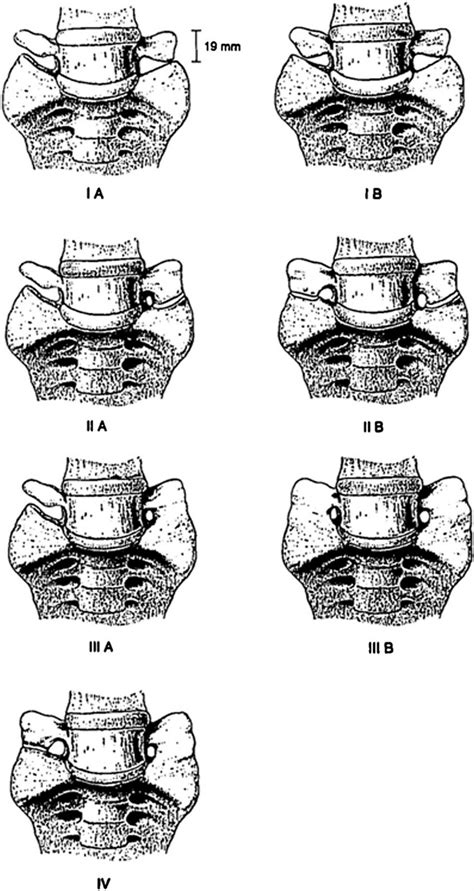 Skull and Spine: Lumbosacral transitional vertebrae