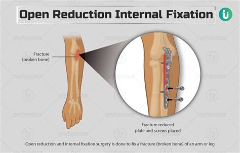 Open reduction internal fixation (ORIF): Procedure, Purpose, Results ...