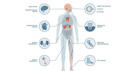 Diabetes Complications | Endocrine Society