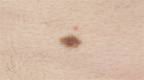 Melanoma images early stages, melanoma pictures early stages, early ...