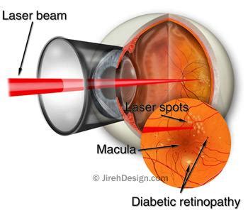 Laser retinal photocoagulation